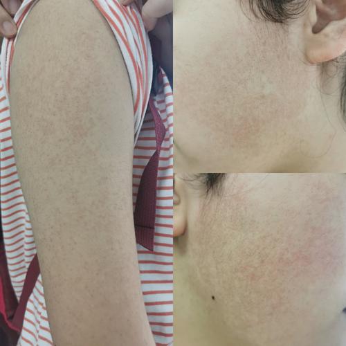 简单说说毛周角化毛发苔癣