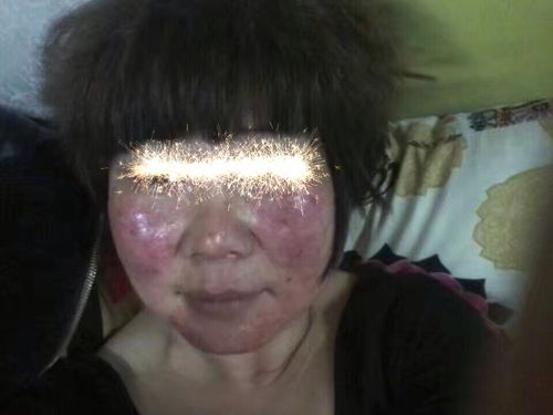 痘 过敏 脸!