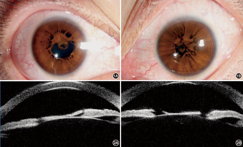 双眼先天性瞳孔残膜