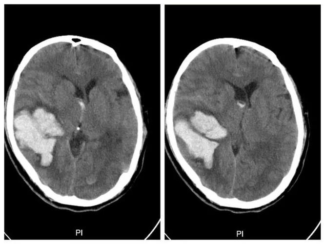 脑叶的出血,也可以用微创的神经内镜手术.