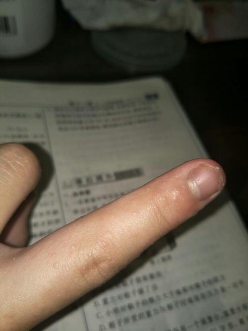 一开始以为是湿疹,可刚刚看有水泡,不知道是不是水痘还是过敏了