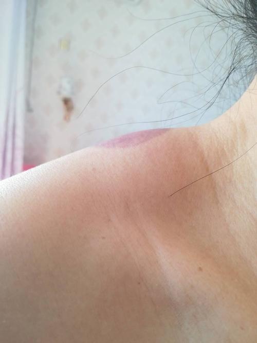 我的肩上鼓起一个包,右肩比左肩厉害,有四年了,请问这什么包?