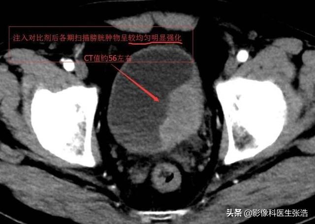 膀胱癌有什么征兆如何预防膀胱癌发生