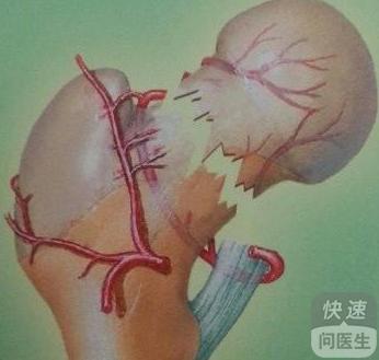 股骨颈骨折如何分型 四种类型最常见