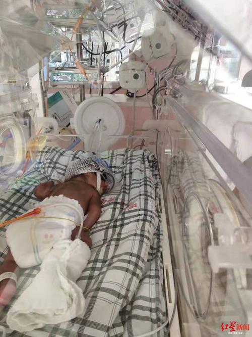 极早产双胞胎出生就进icu一个月已花20余万妈妈还没抱过