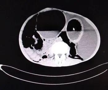 胃明显扩张并大量气液平面,食管下段扩张,请结合临床.