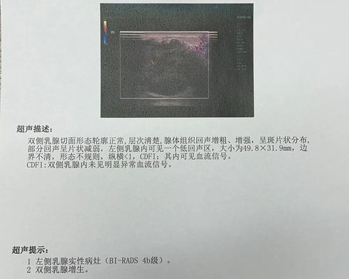 之后的病理诊断,确诊为乳腺癌.