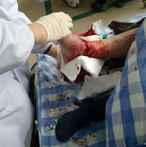 车祸致小腿不全离断伤上虞第三骨伤医院利用显微外科技术为其保肢