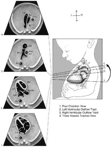 三血管及气管切面 短轴切面(心室及流出道) 主动脉弓 导管弓 上腔静脉