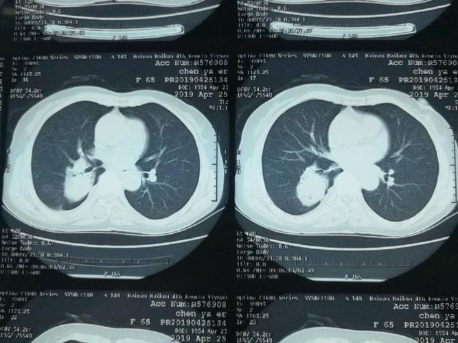 右肺下叶背段占位