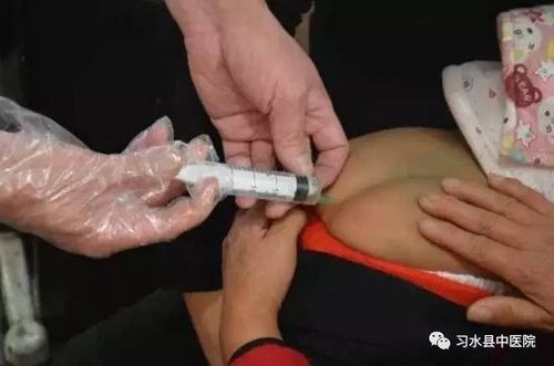 直肠推注给药,减轻小儿痛苦