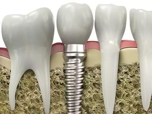 种牙后如何维护能用一辈子?