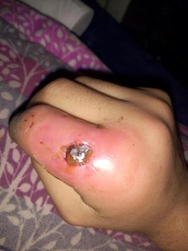 手上有脓块把脓块弄出来后里面是个洞