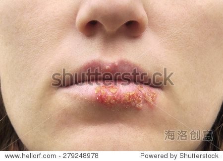 herpes on the lips of the young woman