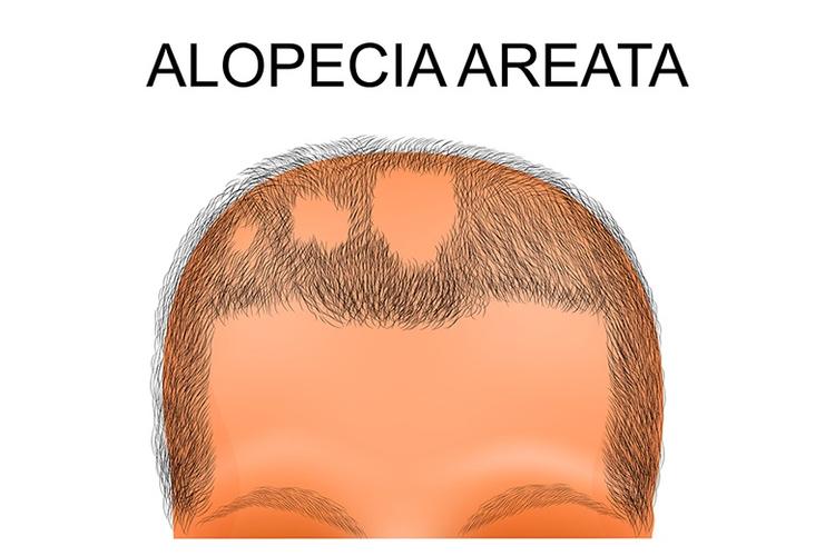 what is alopecia areata?