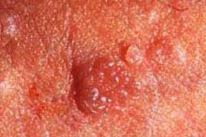 女性尖锐湿疣图片的介绍