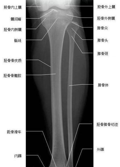 胫腓骨正位—x线
