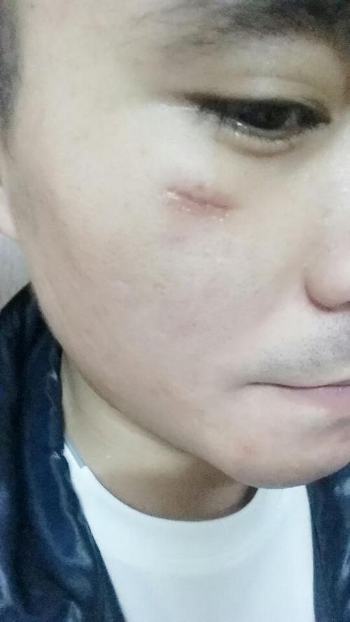 有什么办法去除脸上的伤疤?