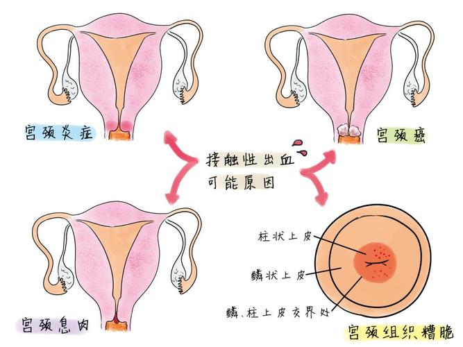 同房后出血警惕疾病找上门