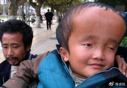 当年喝三鹿的奶粉那些大头娃娃,现在12岁变成了这样,罪人却一再减刑