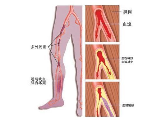 改掉3个不良习惯远离下肢动脉硬化