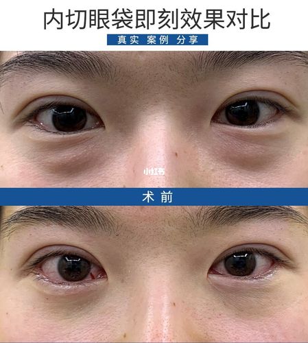内切眼袋_眼袋_内切眼袋_美妆_医美整形