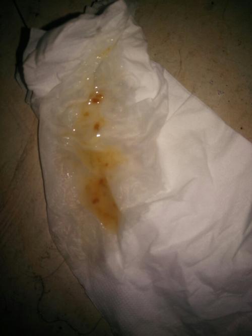 这是生什么病了 为什么精子是这种 求大神告诉我