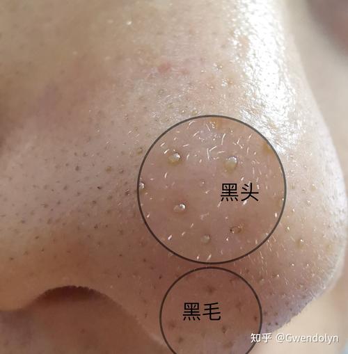 我这样的是黑头吗