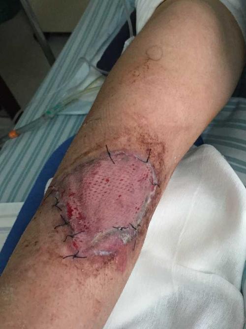 植皮后一周左右.取皮区.