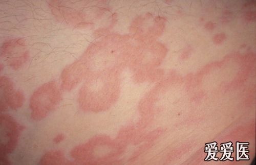 现身说病,急性荨麻疹一例.