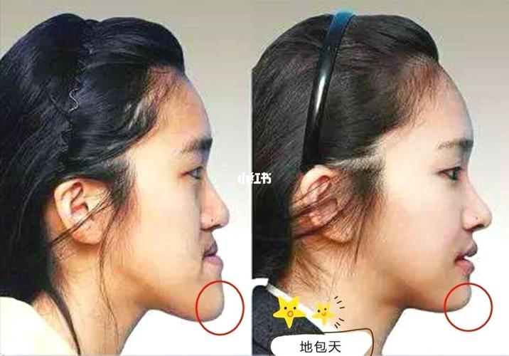 骨相抗衰(9)—下颌角与地包天的关系_地包天_美妆_医