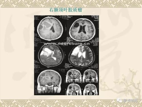 其强化原因为肿瘤新生血管及内皮细胞增生区,可反映血脑屏障破坏的