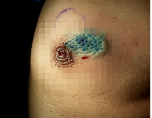 乳头内陷与乳腺癌?你应该了解