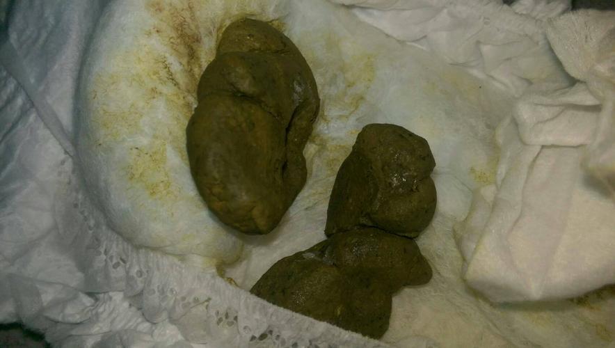 群组里的家长,多半是便秘至少半年以上的头痛案例,肠子变宽,大便粗硬