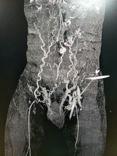 腹壁侧枝形成,右侧精索静脉曲张