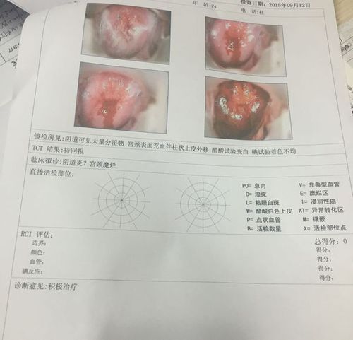 宫颈糜烂2度,检查写着阴道可见大量分泌物,宫颈表面充血伴柱状上皮外