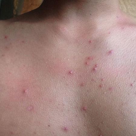 麻烦问一下,这是起的什么痘痘,前胸后背都有的?