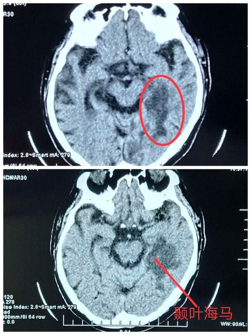 头ct见左侧颞叶海马亚急性梗死灶.