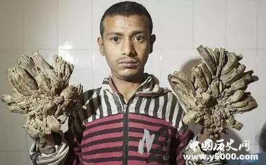 奇人奇事 林天转:全身长壳的"珊瑚人"