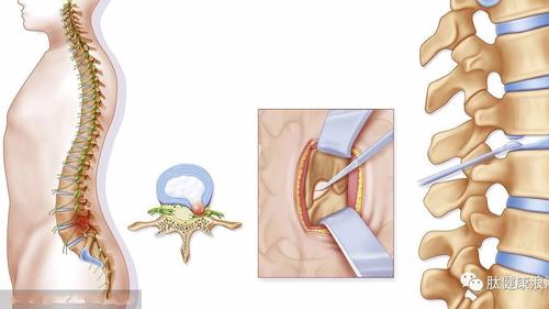 腰椎间盘突出症