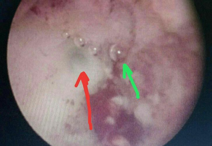 宫腔镜检查之子宫不全纵隔