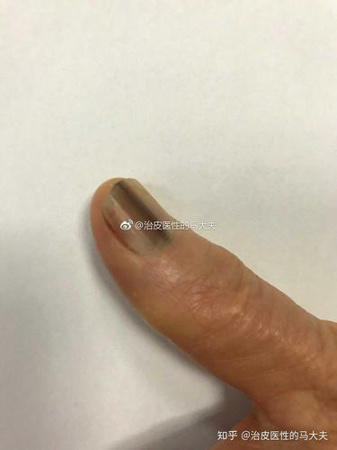 治皮医性的马大夫 的想法: 图1色素斑宽度>3 mm 或者指甲的 1/3,色