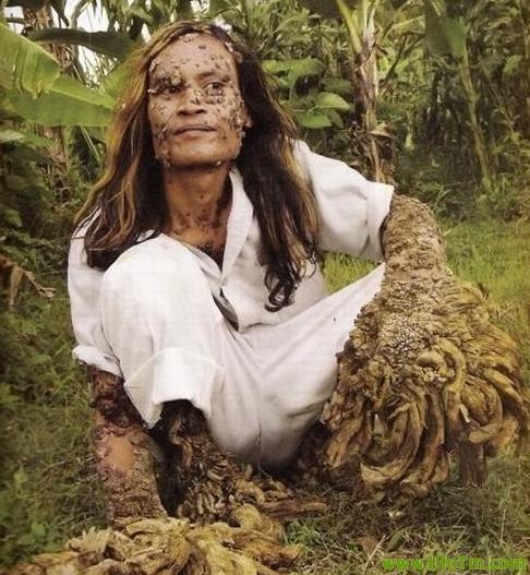 印尼树人的疾病分类