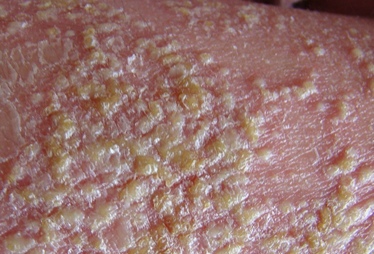 青年脓疱型银屑病内服药