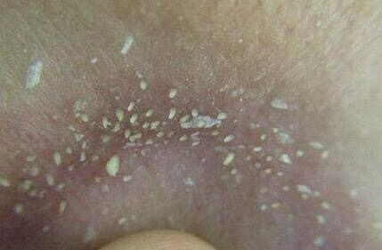 鼻子周围隔一段时间就能挤出很多分泌物,是螨虫吗?