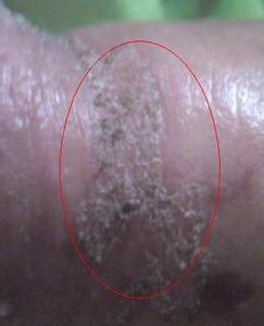 男性龟头掉皮是怎么回事 就是因为这4个原因导致的