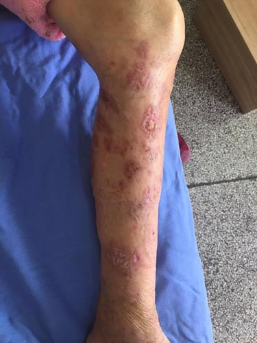 一例带状疱疹后皮损的换药