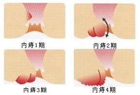 以下四点就是内痔疮的常见症状