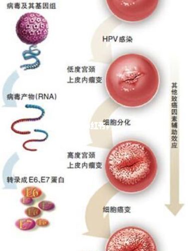 16型和18型感染哪个更严重?_hpv_宫颈癌_医疗健康