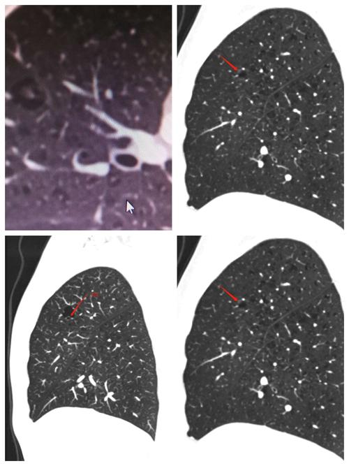 警惕易被误诊为肺大泡的囊腔型癌